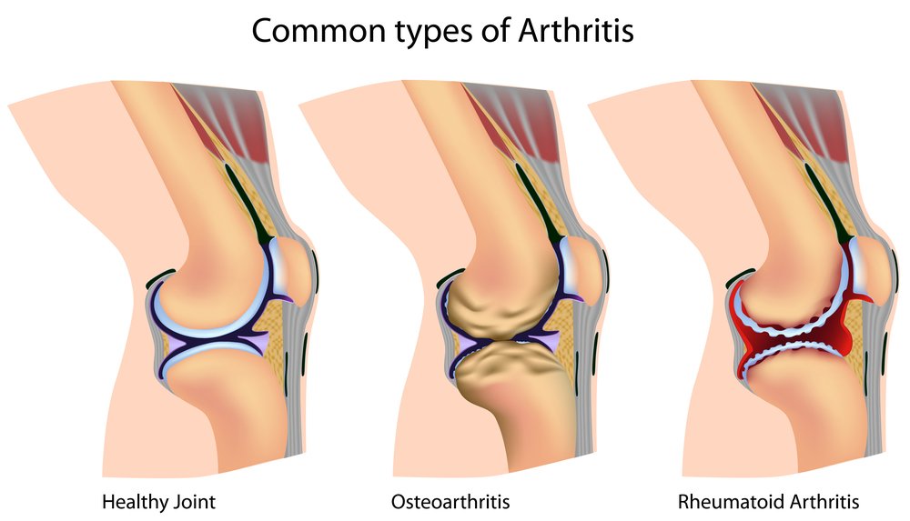 rheumatoid arthritis and osteoarthritis