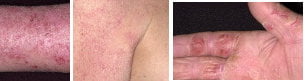 eczema pictures